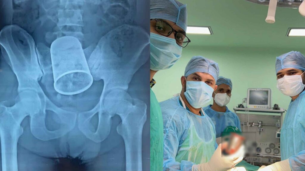 OMG: युवक के मलद्वार में फंसा था स्टील ग्लास, PMCH में 11 डॉक्टरों की टीम ने सर्जरी कर निकाला 1 Picsart 22 10 09 13 42 10 309
