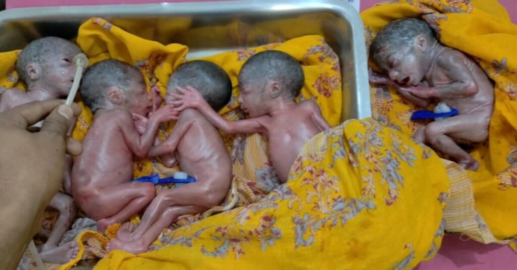 बिहार: 1-2 नहीं, किशनगंज की महिला ने एक साथ 5 बच्चियों को दिया जन्म, डॉक्टर से लेकर परिजन तक सभी हैरान 1 20240505 202335