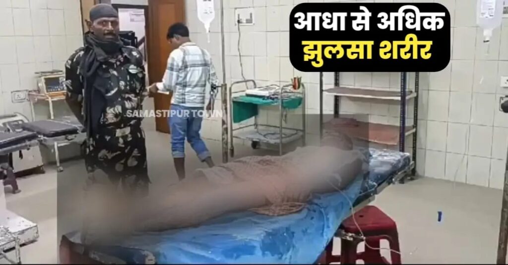बड़ी खबर : समस्तीपुर में झुलसे युवक को पुलिस ने सदर अस्पताल में कराया भर्ती, सरकारी स्कूल के मैडम पर गंभीर आरोप 1 IMG 20240707 WA0012