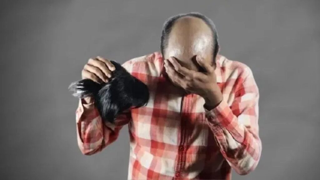 बिहार: गंजापन छुपाने के लिये विग लगाकर शादी की पक्की, लेकिन सात फेरों से पहले खुल गया राज, और फिर लड़की ने... 1 bald boy marriage broken bihar