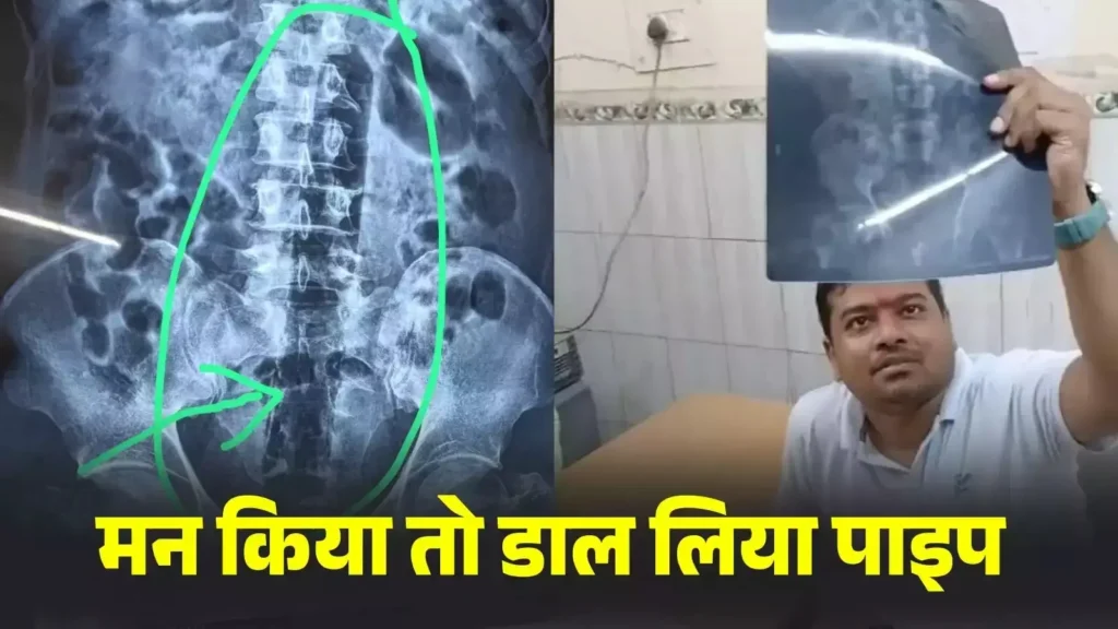 बिहार: इस जेल में कैदी ने खुद के प्राइवेट पार्ट में में डाल ली 7 इंच की पाइप: ऐसा क्यों किया, पूछने पर बोला- 'मुझे मन किया' 1 Picsart 24 08 20 11 47 20 724